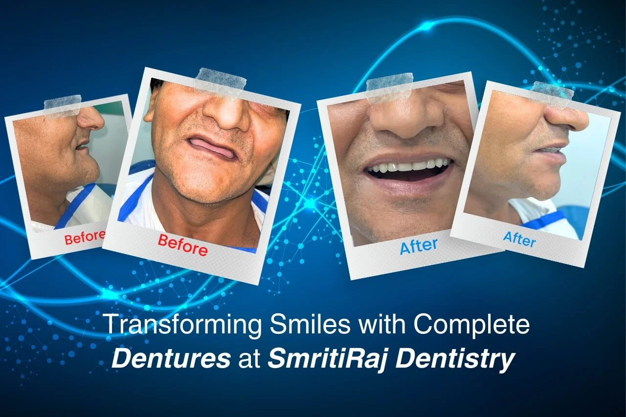 Transforming Smiles with Complete Dentures at SmritiRaj Dentistry